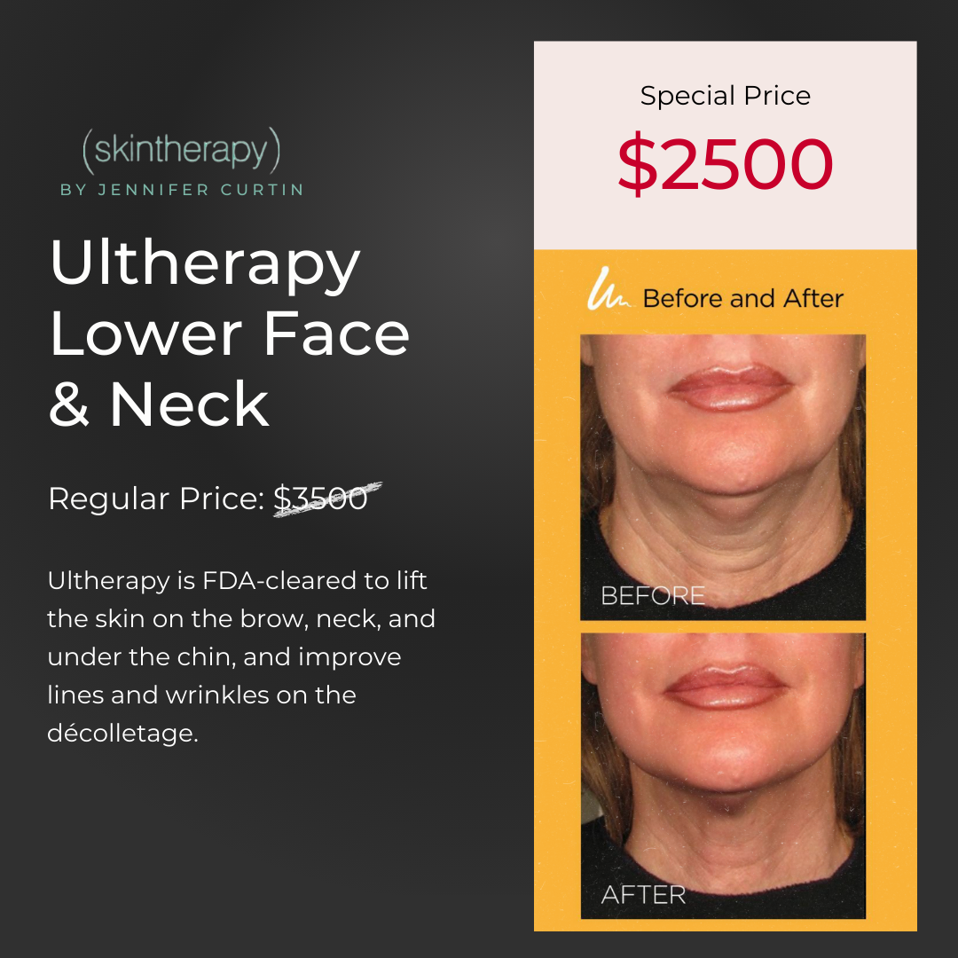 Ultherapy Lower Face & Neck